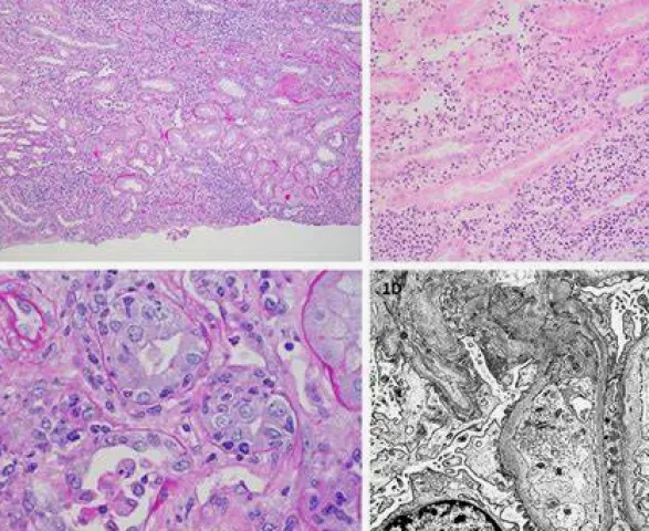 Diagram of kidney showing acute tubulointerstitial nephritis with inflammatory infiltrates in the interstitium