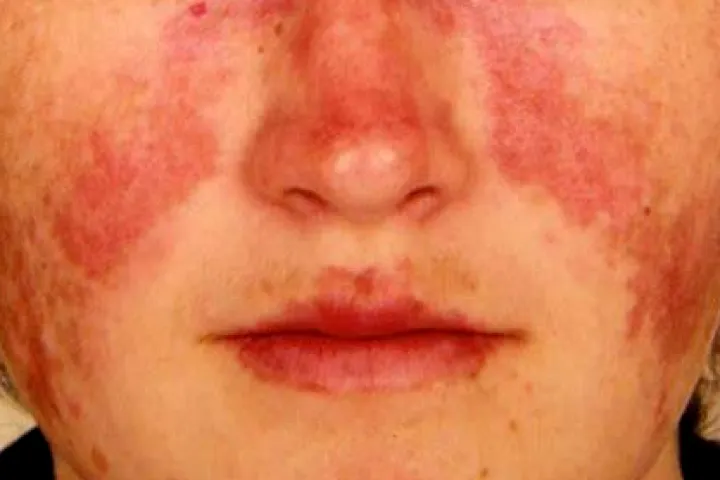 Facial butterfly rash characteristic of cutaneous lupus erythematosus