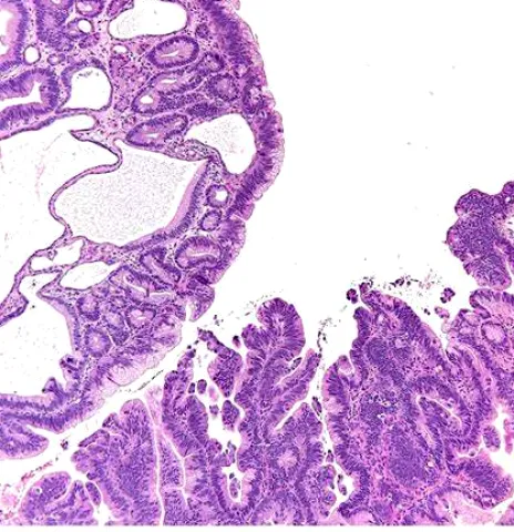 Endoscopic view showing fundic gland polyps on the stomach mucosa