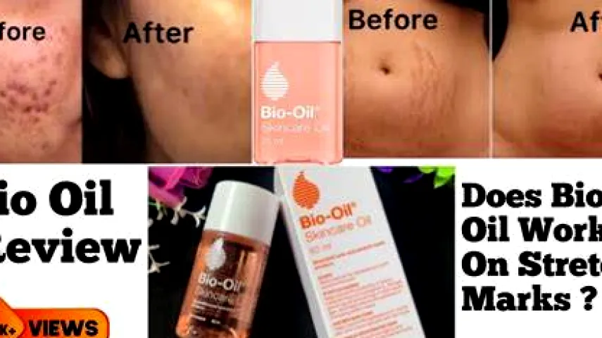 Does Bio-Oil Help Stretch Marks? Evidence, Results, and Safe Use