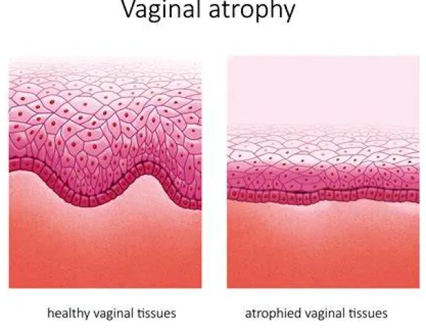 Can Vaginal Atrophy Be Reversed or Successfully Treated?
