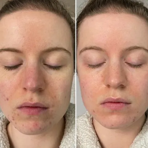 Epiduo Before and After: A Realistic 12-Week Results Timeline