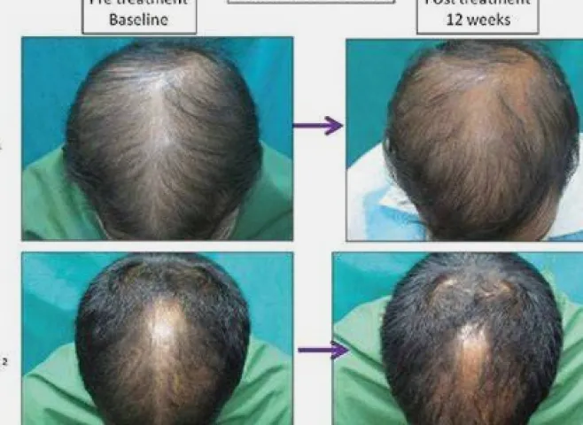 Minoxidil Results Timeline: When to Expect Hair Regrowth
