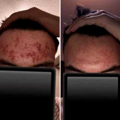 Lymecycline for Acne: Results Timeline, Correct Use and Safety
