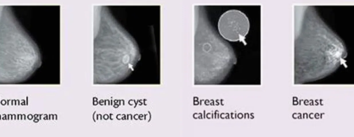What Breast Cancer Lumps and Related Breast Changes May Look Like