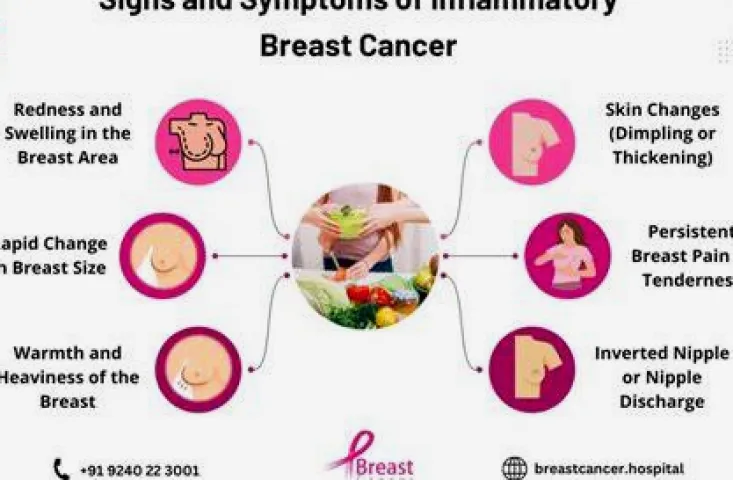 What Does Inflammatory Breast Cancer Look Like in Its Early Stages?