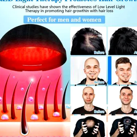Red Light Therapy for Hair Loss: Evidence, Results, and At-Home Use