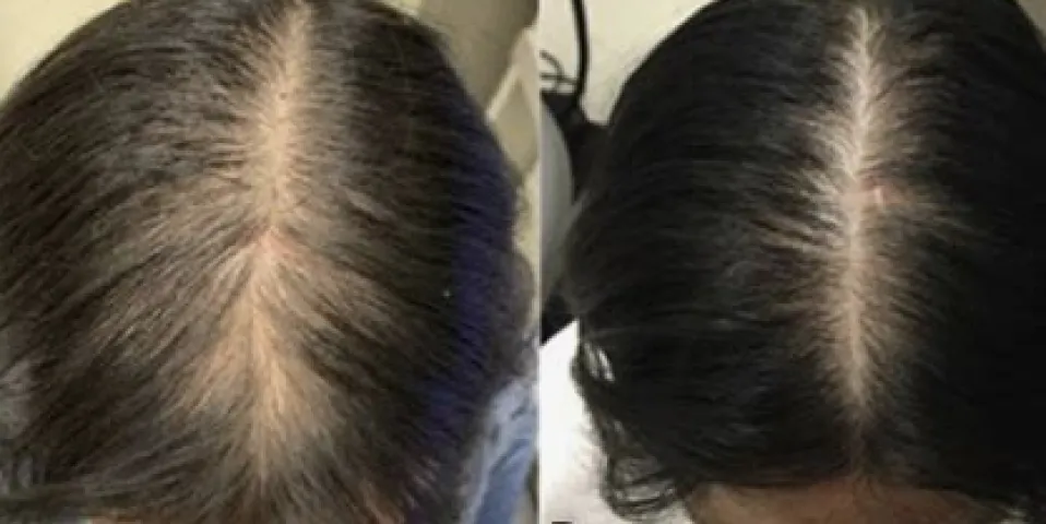 Spironolactone for Female-Pattern Hair Loss: Evidence, Dosing, Results, and Risks
